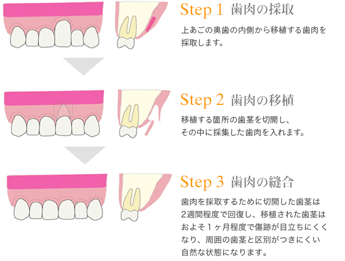 Step1 上あごの奥歯の内側から移植する歯肉を採取します。Step2 移植する箇所の歯茎を切開し、その中に採集した歯肉を入れます。Step3 歯肉を採取するために切開した歯茎は ２週間程度で回復し、移植された 歯茎はおよそ1ヶ月程度で傷跡目立ちにくくなり、 周囲の歯茎と区別がつきにくい自然な状態になります。